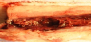 Visual assessment of explanted tissue treated with standard of care demonstrates lack of tissue apposition with gaps for fluid accumulation and weakened repair.