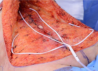 Manifold branches placed in the abdominoplasty open tissue plane