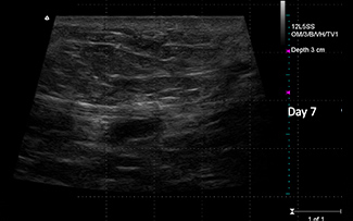 Representative ultrasound from post-op day 7